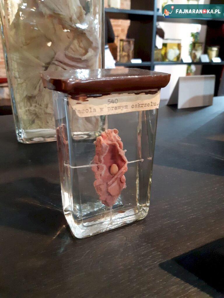 Preparat z fasolą w prawym oskrzelu w Muzeum Historii Medycyny we Fromborku.